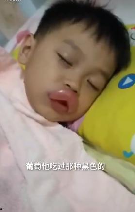 吃瓜过敏嘴肿,揭秘过敏反应背后的真相